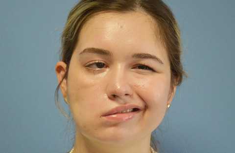 facial-paralysis-treatment-pre-op-woman-turkey