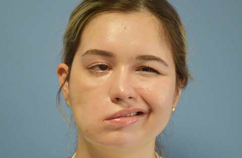 facial-paralysis-treatment-pre-op-woman-turkey