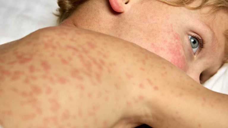 measles_20260401_133602603