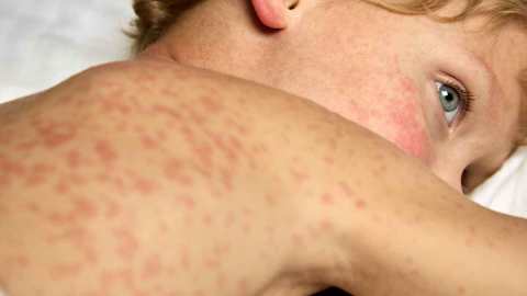 measles_20260401_133602603