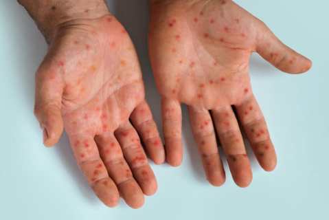 25-measles-brain-complications