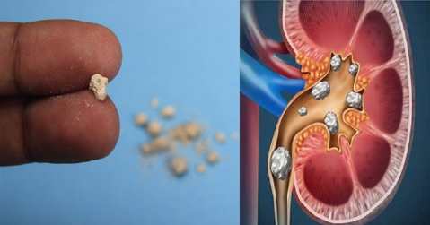 kidney_original_1698116284