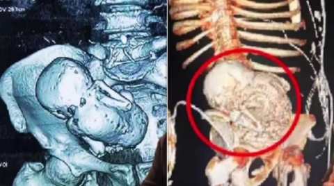 প্রসবের ভয়ে হাসপাতাল থেকে পালিয়েছিলেন নারী, ৩৬ বছর পর পেট থেকে মিলল ‘পাথর শিশু’
