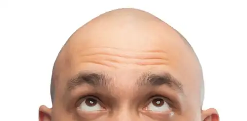 The-hidden-racist-history-of-hair-loss