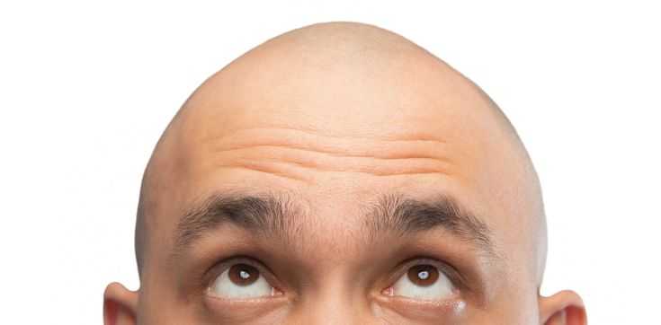 The-hidden-racist-history-of-hair-loss