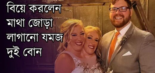 বিয়ে করলেন মাথা জোড়া লাগানো যমজ দুই বোন | Twin Sister